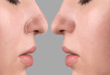 Nose Job