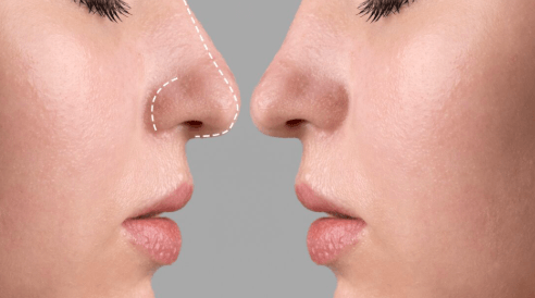 Nose Job