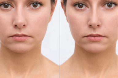 Rhinoplasty